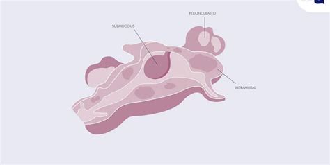 Pelvic Adhesions and how they affect your fertility