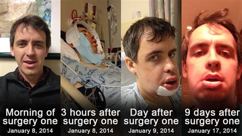 Jaw Surgery Before and After Pictures — Jaw Surgery Recovery Tips