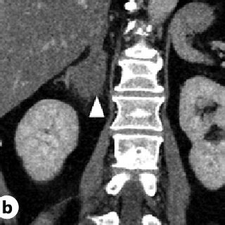 Axial (a), coronal (b), and sagittal (c) images on contrast-enhanced ...