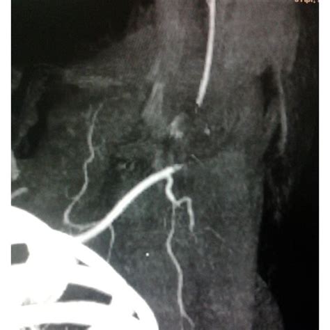 (a) Preoperative CT angiogram showing injury to left axillary artery by ...