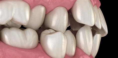 The Causes and Impacts of Tooth Misalignment