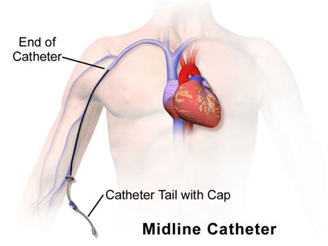 Midline_Catheter – SIFSOF