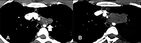 Prechemotherapy Axial Contrast Enhanced Computed Tomography Cect