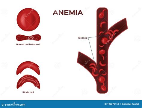 Normal Red Blood Cell And Sickle Cell Vector Anemia Stock Vector