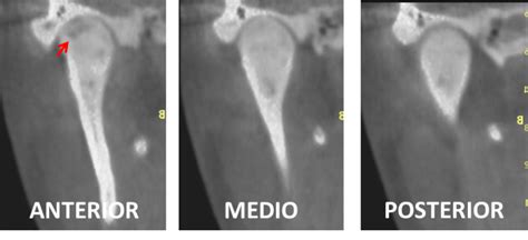 Osteítis Subcondral en la ATM Dento Metric Radiología Dental Oral