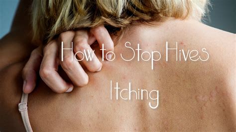 Urticaria How To Treat Itching From Hives Hubpages