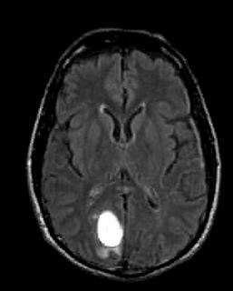 MRI Brain Images (a).benign (b)malignant images | Download Scientific ...