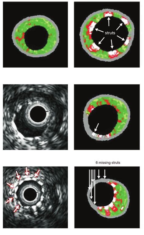 IVUS And IVUS VH Images Before And After Stent Implantation A Stent