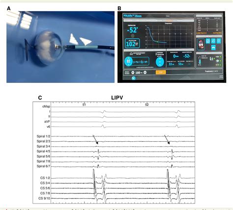 Figure 1 From Novel Cryoballoon Ablation System For Pulmonary Vein Isolation Multicenter