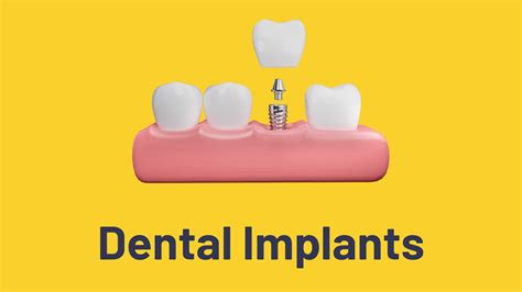 Dental Implants In 97077 Healing Cap ø55 H2 For Tri Dental Implants Ag