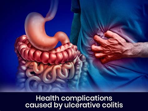 Health Complications Caused By Ulcerative Colitis By Apurba