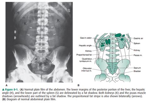 Plain Film Of The Abdomen Technique And Normal Imaging