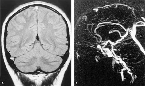 28a B Thrombosis Of The Superior Sagittal And Right Transverse Sinus