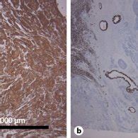 Immunohistochemical Staining Of The Tumor Cells Showed Cytokeratin