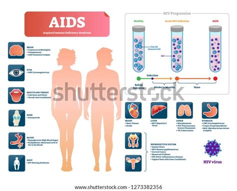 Aids Or Hiv Vector Illustration Labeled Medical Diagram With Virus