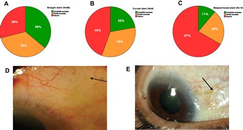 Learning Curve And One Year Outcome Of XEN 45 Gel Stent Implantation I