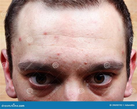 Boutons Dacné Sur Le Visage Photo Stock Image 39690192