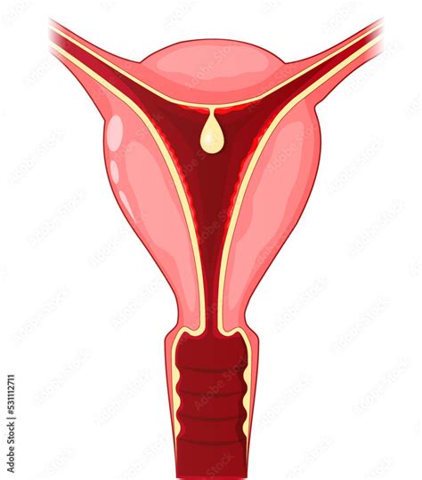 Uterine Polyp Human Uterus With Endometrial Polyp Stock Vector Adobe