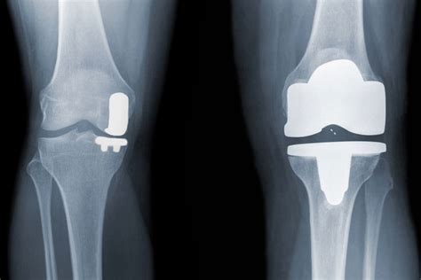 Partial Knee Replacement – Sumit Rana, MD