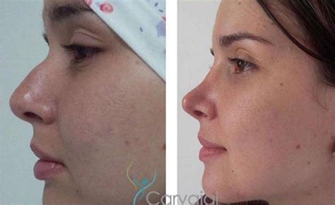 How To Narrow The Nostrils With Nostril Surgery Rhinoplasty Cost