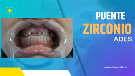 Puente De Zirconio Ades Cl Nica Dental Avanzada Youtube