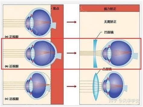 近视、老花为什么不可以抵消？就是这个原因！ 知乎