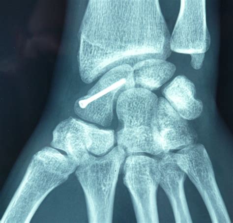 fracture du scaphoide carpien Institut Européen de la Main