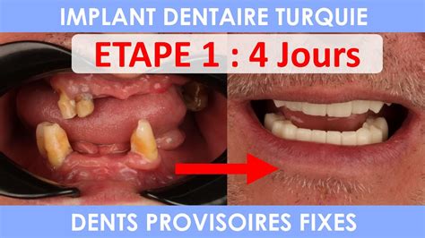 Implant dentaire en Turquie Implantation bouche complète YouTube