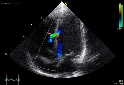 Tests/Diagnosis - Ischaemic heart disease