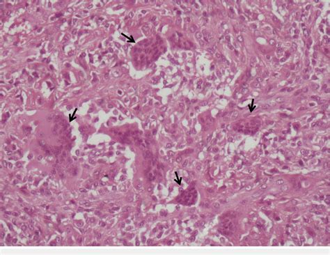 Histopathological examination shows the multinucleated giant cells... | Download Scientific Diagram