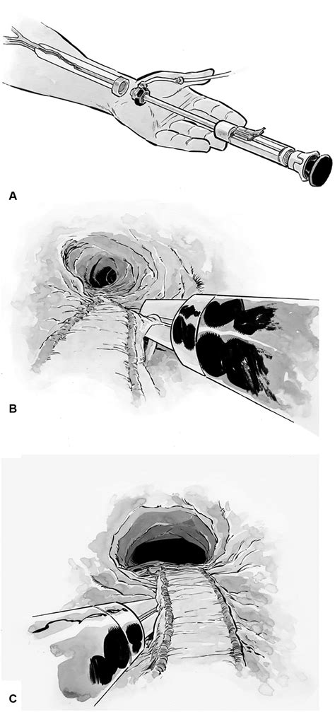 A Modified Approach For Totally Endoscopic Touchless Radial Artery