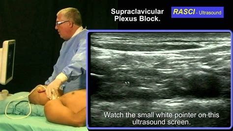 Ultrasound Guided Supraclavicular Plexus Block Youtube