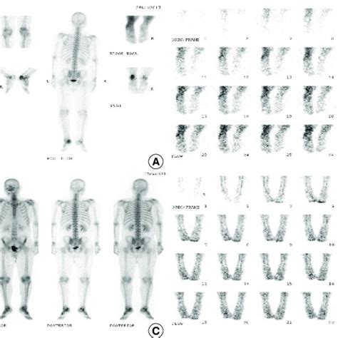 A B Preoperative 3 Phase Bone Scan Findings Of Case 2 Increased