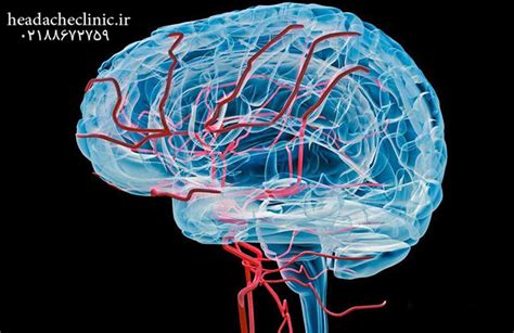 خونرسانی به مغز کلینیک سردرد تهران