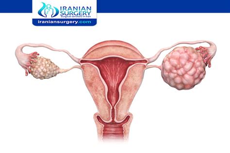 Stage ovarian cancer|Ovarian cancer progression timeline |Iranian Surgery