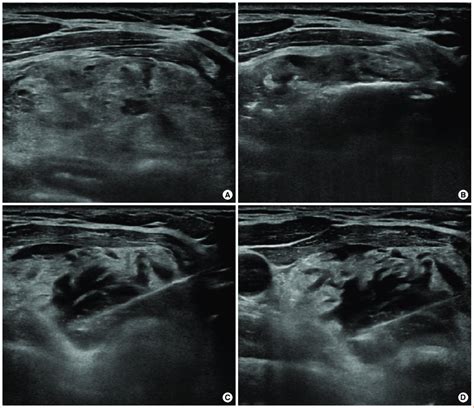 Cm Thyroid Nodule