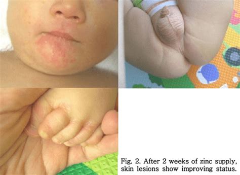 Figure From A Case Of Zinc Deficiency Dermatitis In Breast Milk Fed