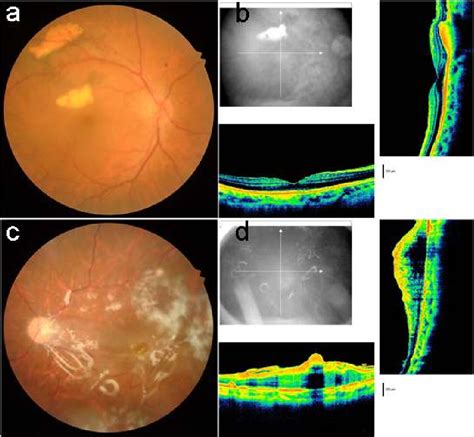 Figure 1 from Pathway of Subarachnoid Hemorrhaged Blood into Eye ...