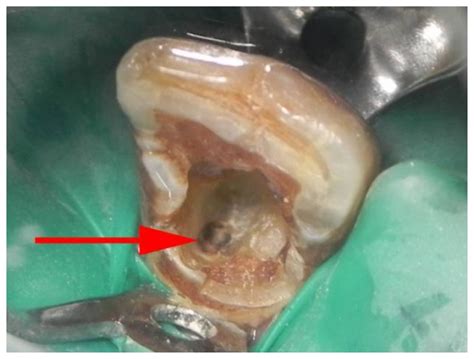 Calcific Metamorphosis A Review Abstract Europe Pmc