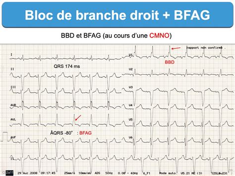 Bloc Bifasciculaire E Cardiogram