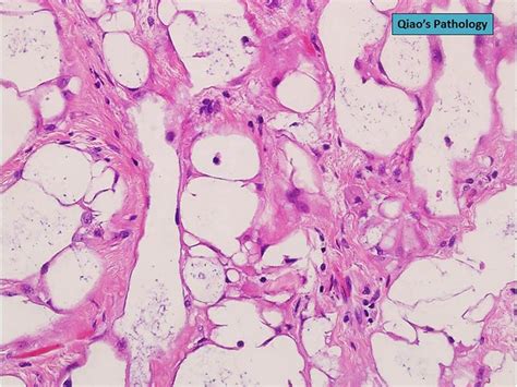 Flickriver Photoset Uterine Adenomatoid Tumors By Qiao S Pathology