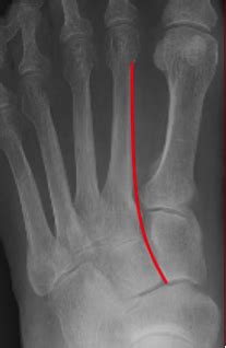 Lisfranc Injuries St Joseph S Health Center Emergency Medicine