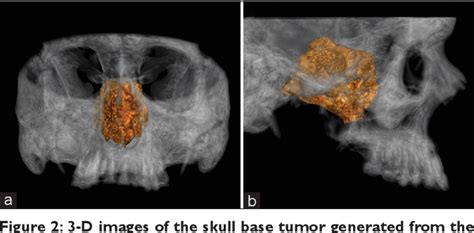 Figure 2 From A Rare Case Of Giant Cell Tumor Involving The Clivus Resected Through Le Fort I