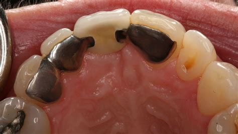 Zirconia Bridge Technique Conservative Esthetic Tooth Replacement