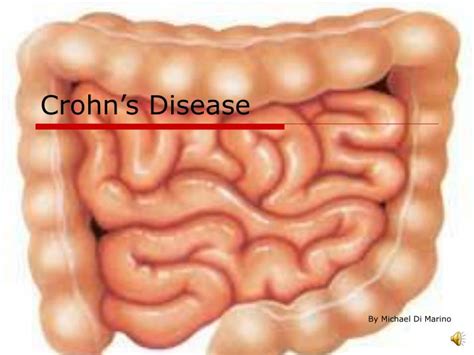 Ppt Crohn’s Disease Powerpoint Presentation Free Download Id 4954621