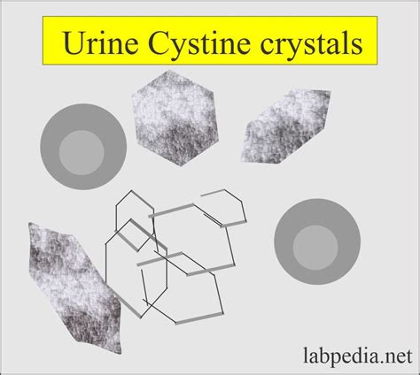 Radiographic Dye Crystals In Urine