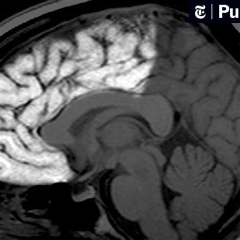 Brain Cancer Mri Images Lobes Symmetry Dataset Kaggle