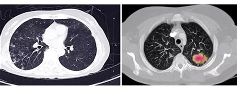 CT Scan of Lungs - Photos for Detecting Lung Cancer | MyLungCancerTeam