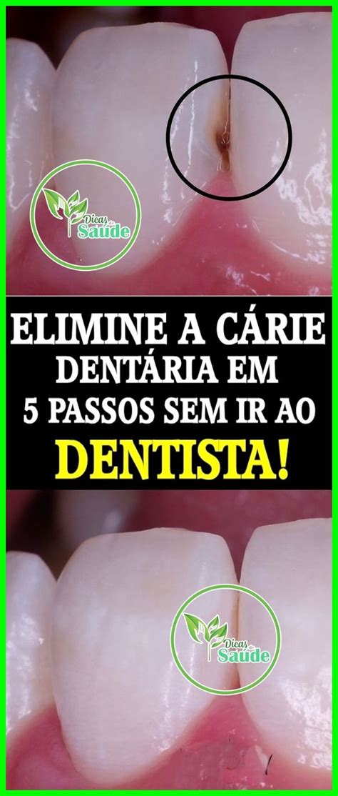 7 Receitas Para Eliminar As Cáries Dentária Sem Ir Ao Dentista Em 2020