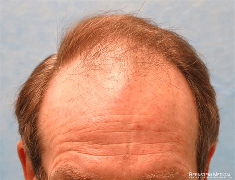 Patient Khi Bernstein Medical Center For Hair Restoration